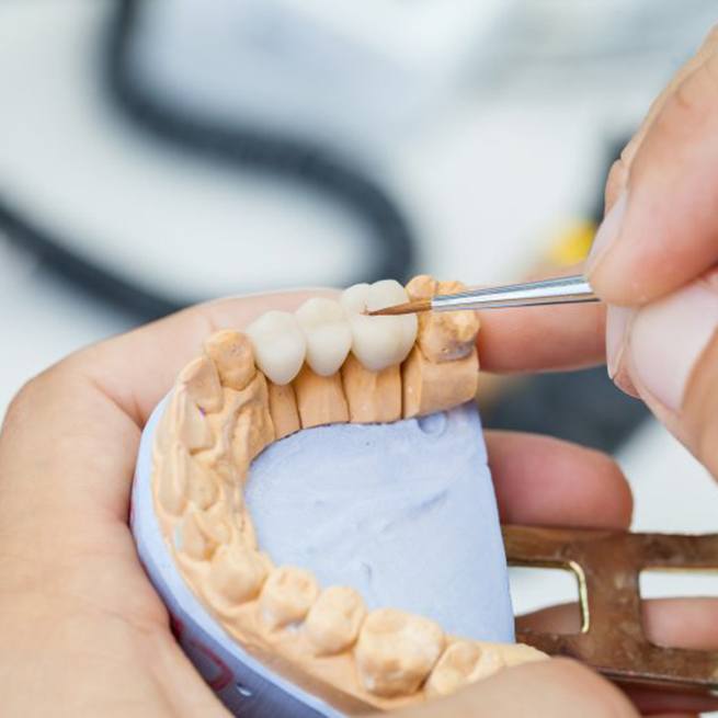 Dental bridge being crafted