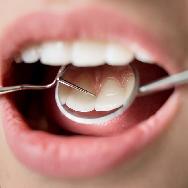 Closeup of teeth reflected in dental mirror during exam