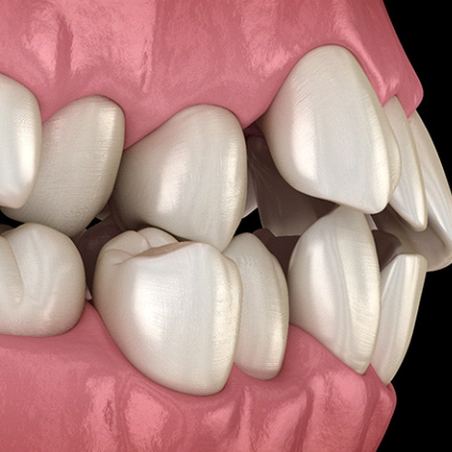 Illustration of crooked teeth, an indication for clear aligners