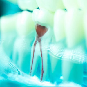 illustration of infected pulp in tooth