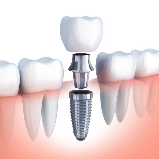 Animated dental implant supported dental crown placement