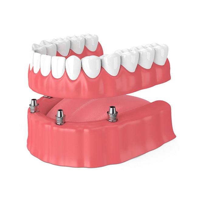 implant dentures in Burien