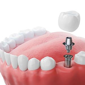 Illustration of implant, abutment, and crown in lower dental arch