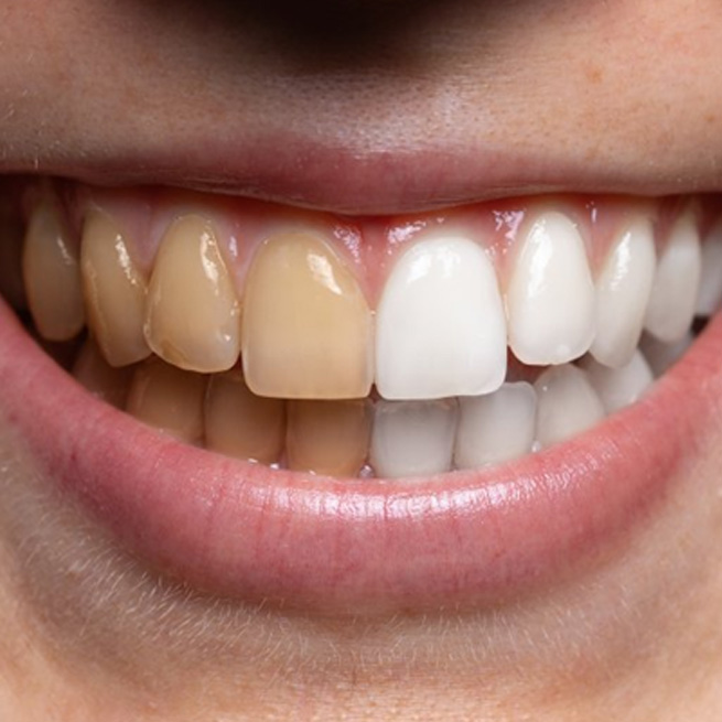 Before and after teeth whitening results 