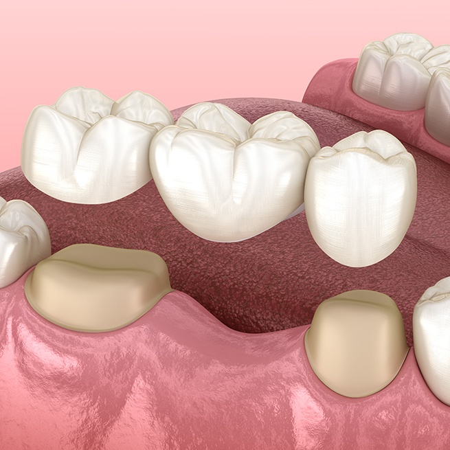 Animated fixed bridge tooth replacement placement