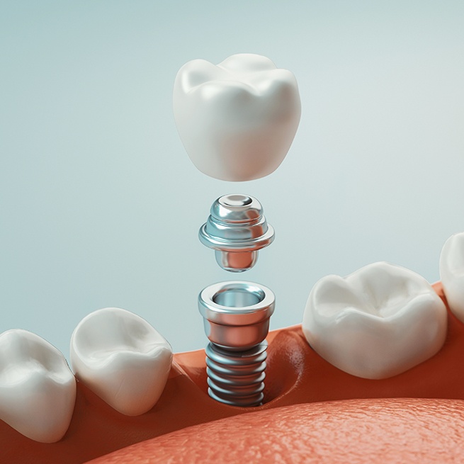 Animated dental implant supported dental crown placement