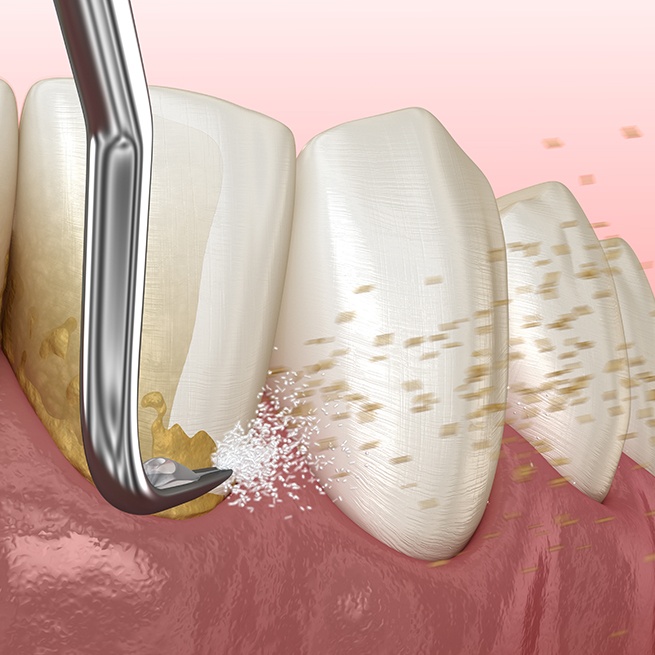 Animated scaling and root planing periodontal therapy