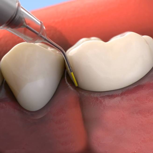 Animated Arestin antibiotic therapy treatment