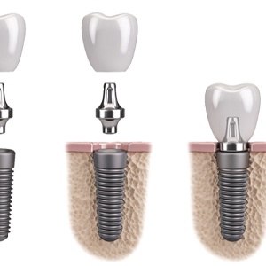diagram showing the parts of a dental implant