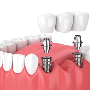 A digital image showing a dental implant bridge sitting in the lower arch in Burien