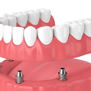A digital image of 4 dental implants in Burien on the lower arch of the mouth and full dentures attached