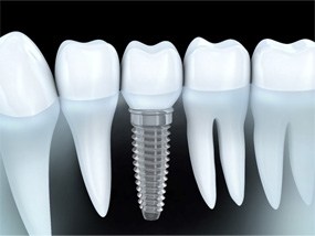 diagram of implant dentures 