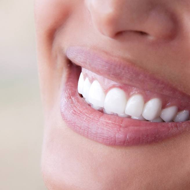 Closeup of woman with veneers smiling