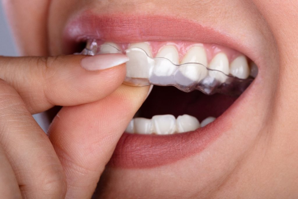 Closeup of patient putting clear aligners on top teeth