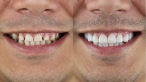 a man showing his small teeth before and after they were fixed
