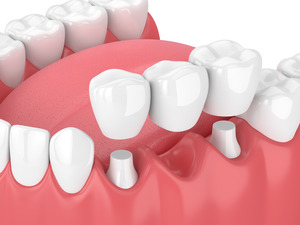 3D render of a dental bridge